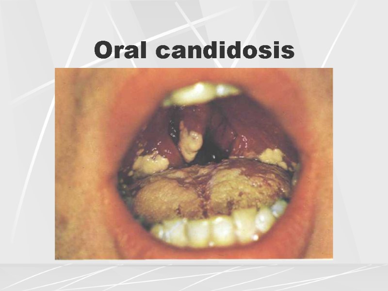 Oral candidosis